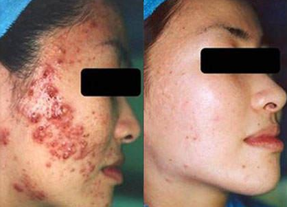 Cara Menghilangkan bekas Jerawat