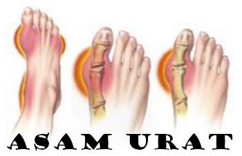 Obat Asam Urat Tradisional Alami dan Herbal