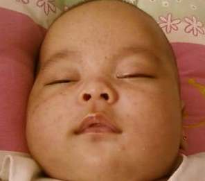 Penyebab Bintik Merah Pada Bayi di Kulit dan Wajah
