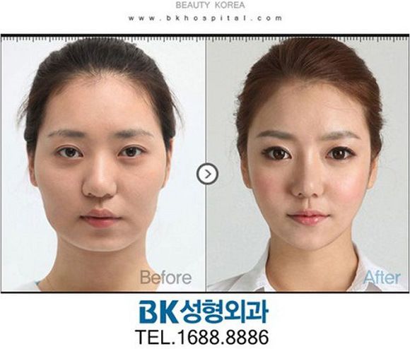 foto-operasi-plastik-korea-30