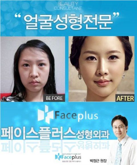 foto-operasi-plastik-korea-34