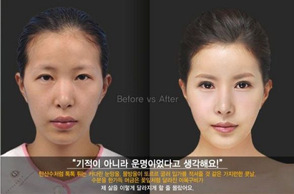 foto-operasi-plastik-korea-37