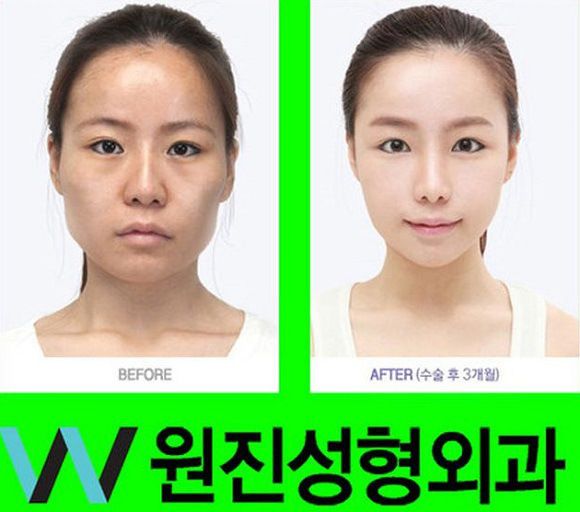 foto-operasi-plastik-korea-39